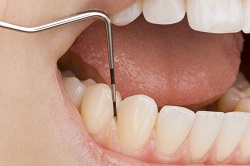 歯ぎしりと歯周病